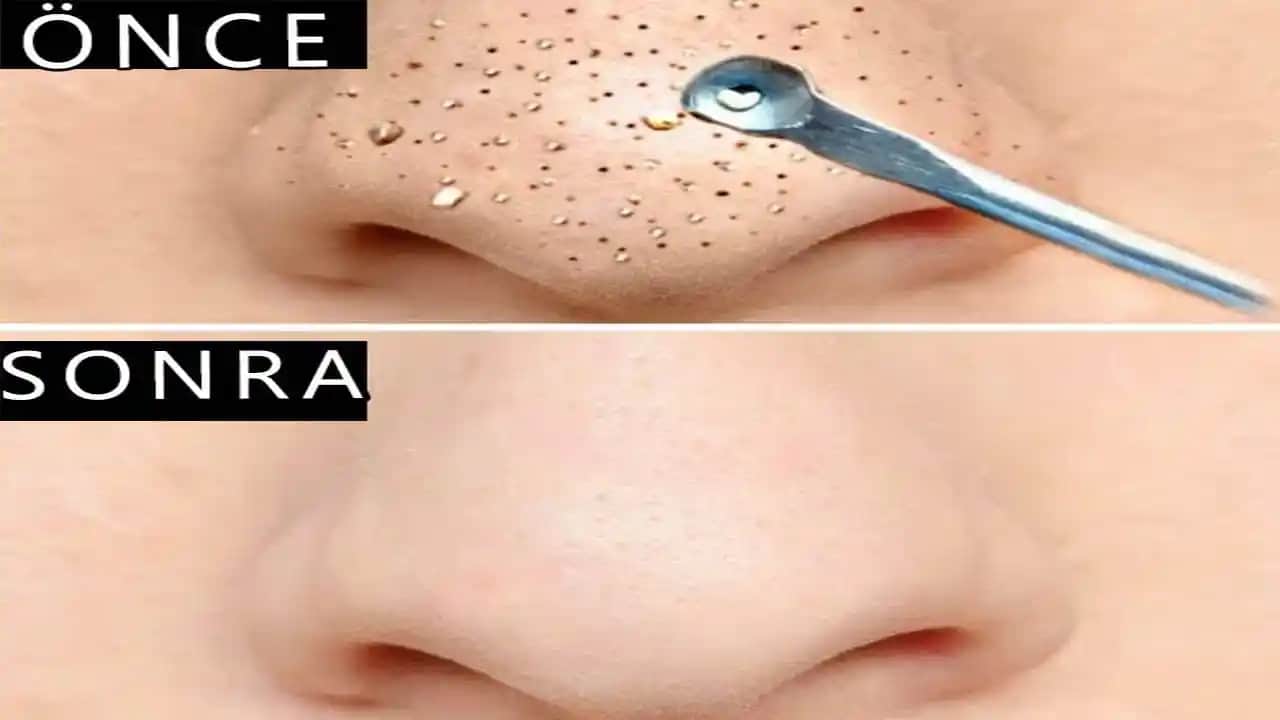 Burun Kenarı Siyah Nokta Problemi ve Çözüm Yolları: Etkili Bakım ve Tedavi Yöntemleri