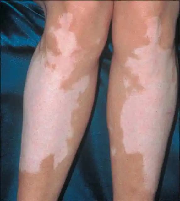 Ciltte Beyaz Lekeler Nedenleri, Tedavi Yöntemleri ve Korunma İpuçları