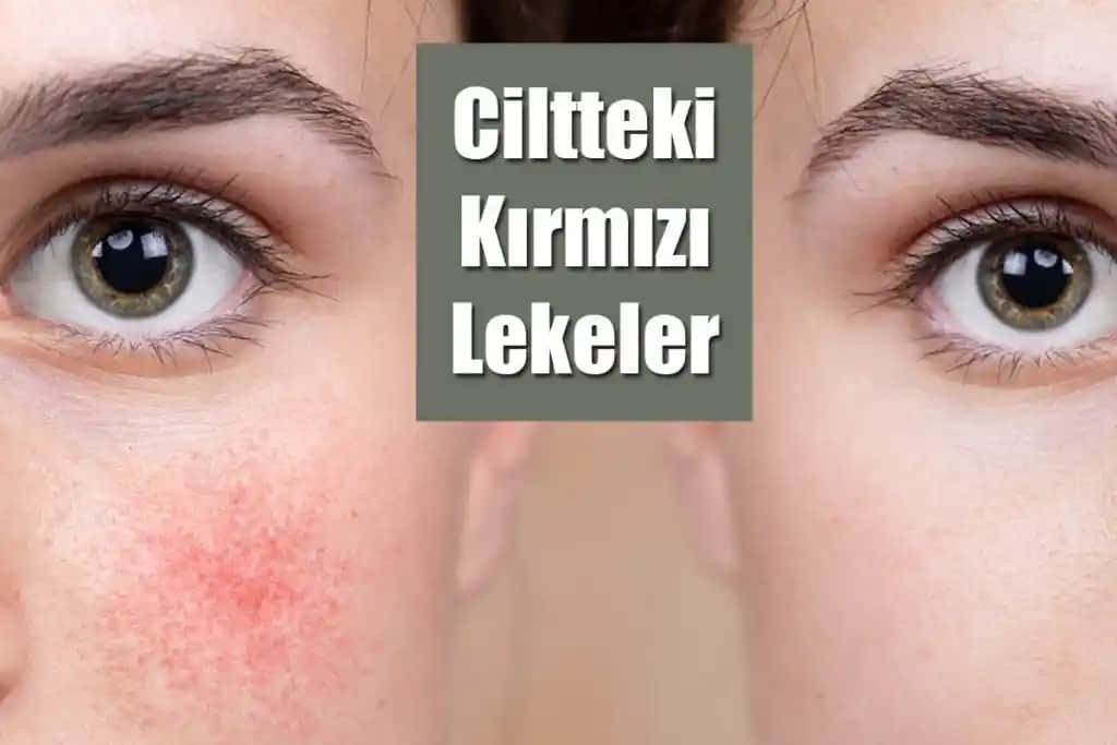 Ciltte Çıkan Lekelerin Nedenleri, Tedavi Yöntemleri ve Koruyucu İpuçları
