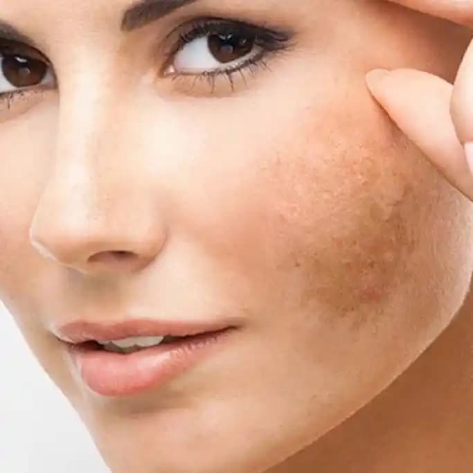 Ciltte Koyu Lekelerin Nedenleri ve Etkili Tedavi Yöntemleri Hakkında Detaylı Bilgi