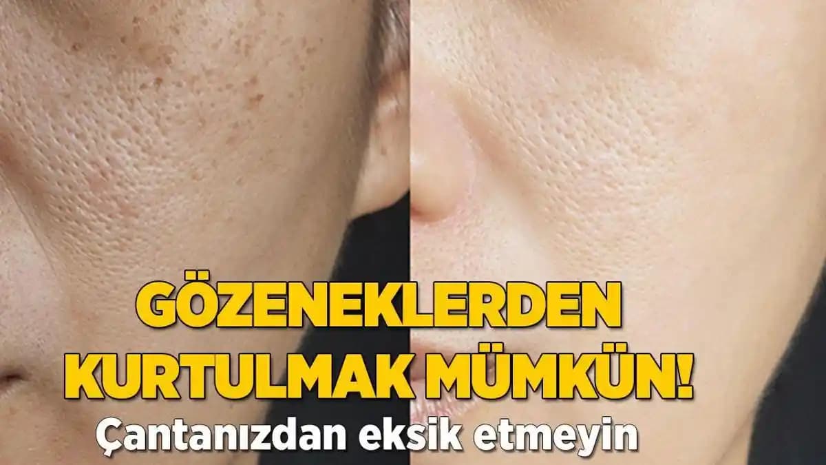 Ciltteki Gözeneklerin Nedenleri ve Sağlıklı Görünüm İçin Etkili Yöntemler