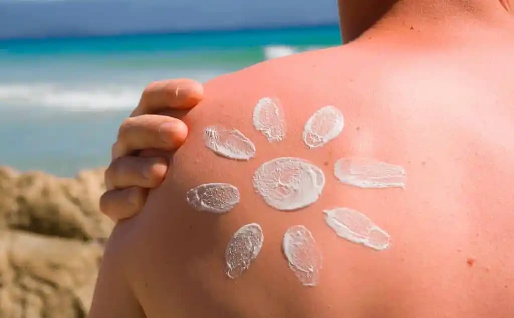 Deniz Yanıklarına Karşı Doğal ve Etkili Çözümler İçin Uzman Tavsiyeleri