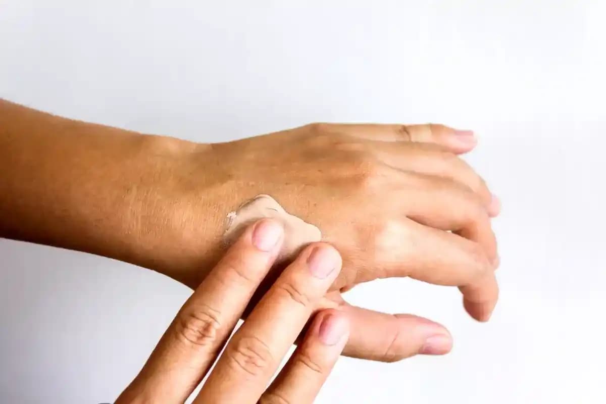 Ellerinizde Çatlaklar ve Kanamalar: Nedenleri ve Etkili Tedavi Yöntemleri