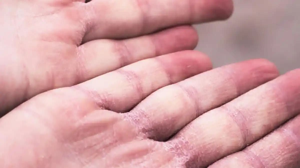 Ellerinizin Kuru ve Çatlak Olmasını Önlemek İçin Etkili Bakım Yöntemleri