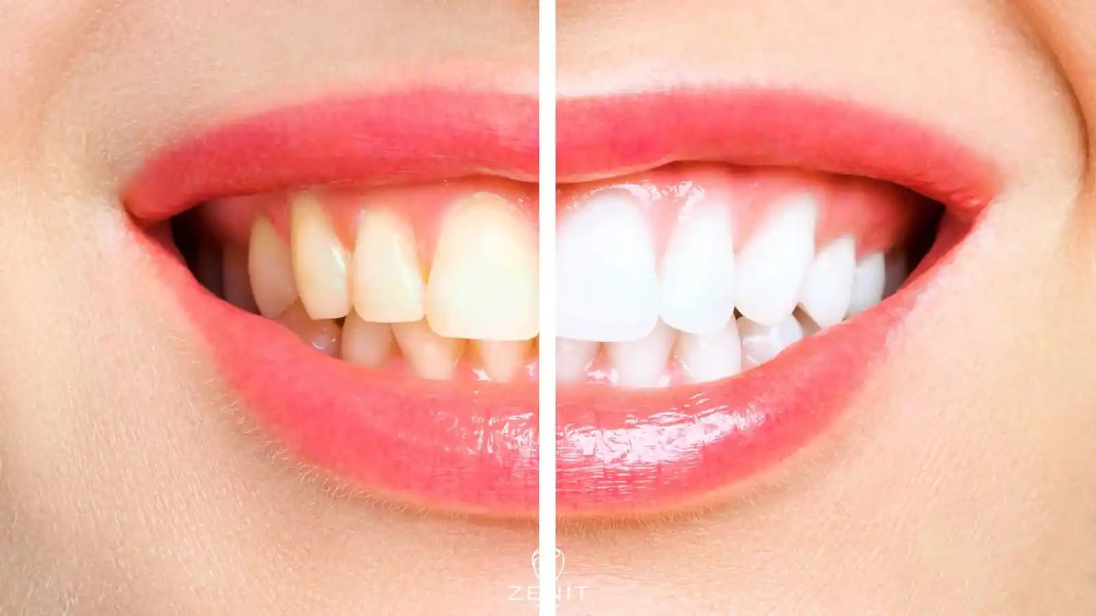 En İyi Diş Beyazlatma Yöntemleri ve Gülüşünüzü Parlatmanın En Etkili Yolları