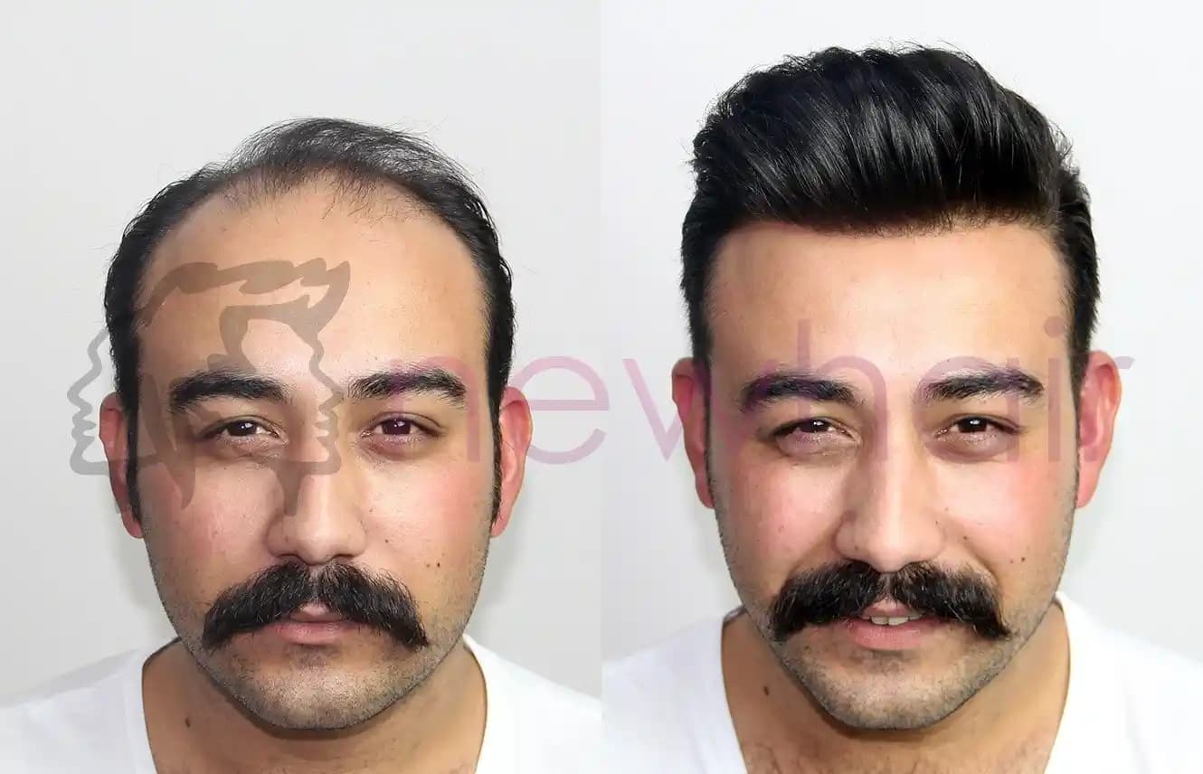 Erkek Protez Saç Nedir ve Doğal Görünüm Sağlayan Modern Çözümler