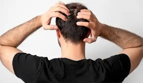 Erkeklerde Kepek Sorunu: Nedenleri, Çözüm Yolları ve Etkili Bakım İpuçları