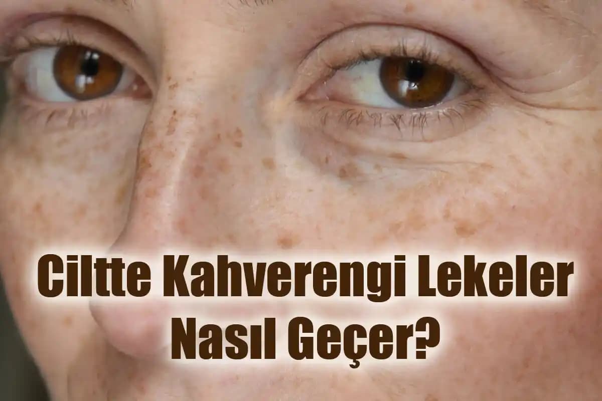 Göz Kahverengi Leke Nedenleri, Tedavi Yöntemleri ve Bakım İpuçları