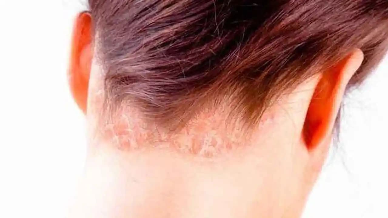 Saç Gözenekleri Tıkanıklığını Önleme ve Açma Yöntemleri Rehberi