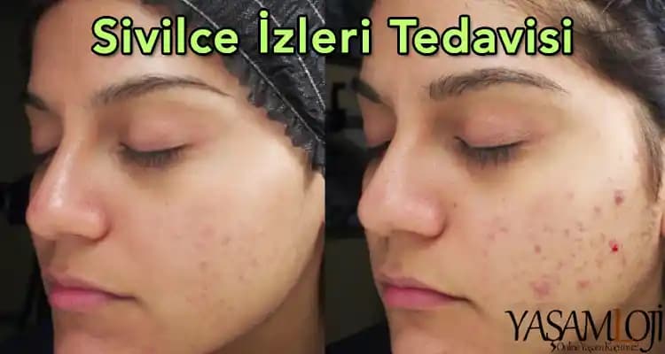 Sıkılan Sivilce İzlerinin Geçmesi İçin Etkili Yöntemler ve Uzman Tavsiyeleri