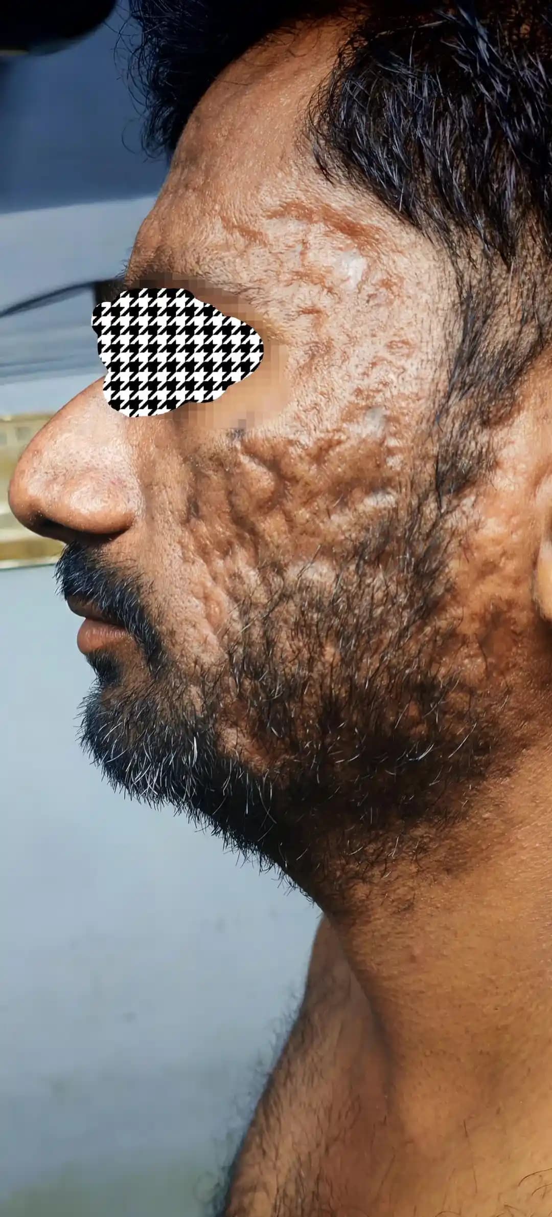 30 Yaşında Akne İzleri ve Etkili Tedavi Yöntemleri: Lazer, Subcision ve Peeling