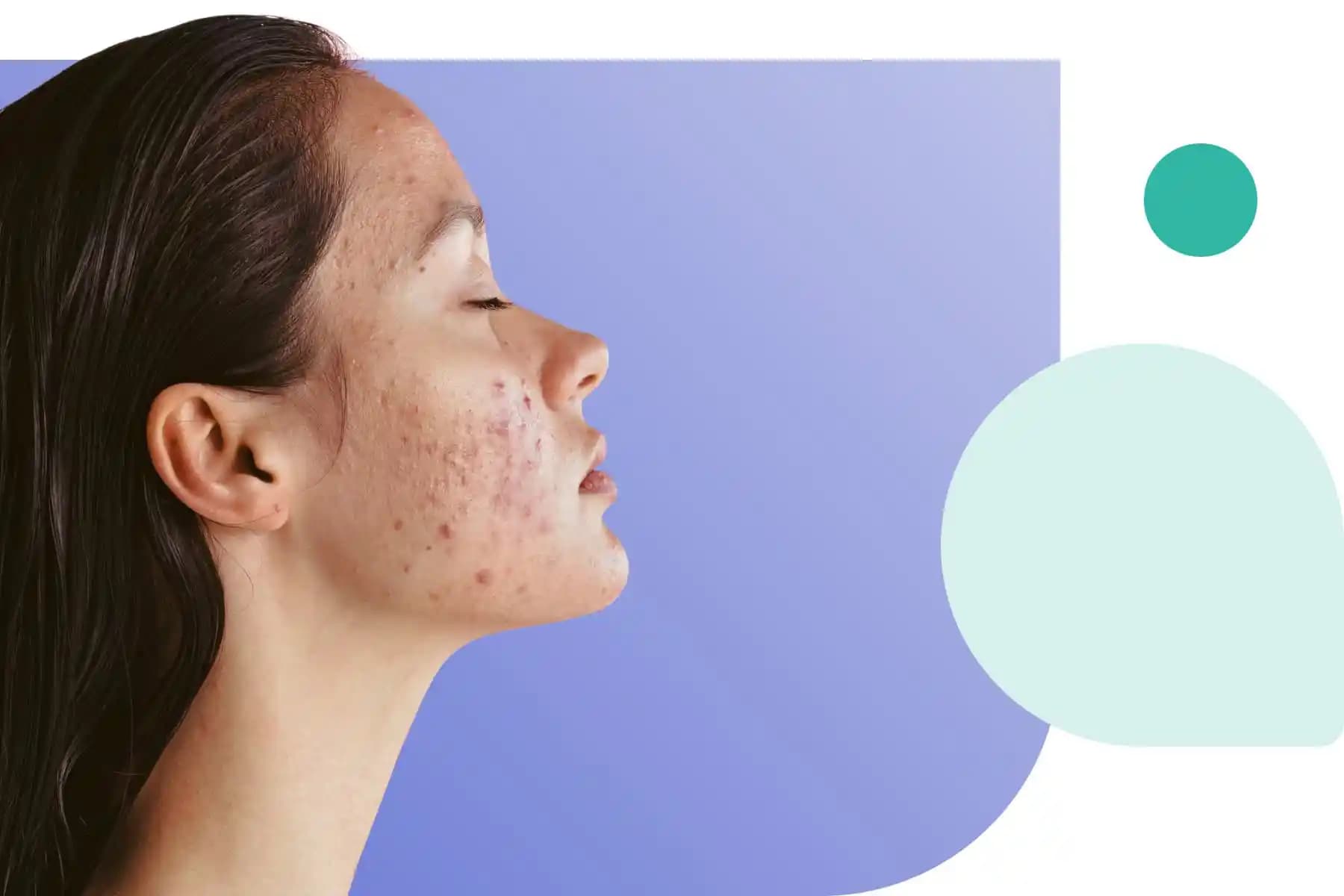 Accutane (İzotretinoin) Tedavisinde Purging Süreci ve Yönetimi Hakkında Bilgiler