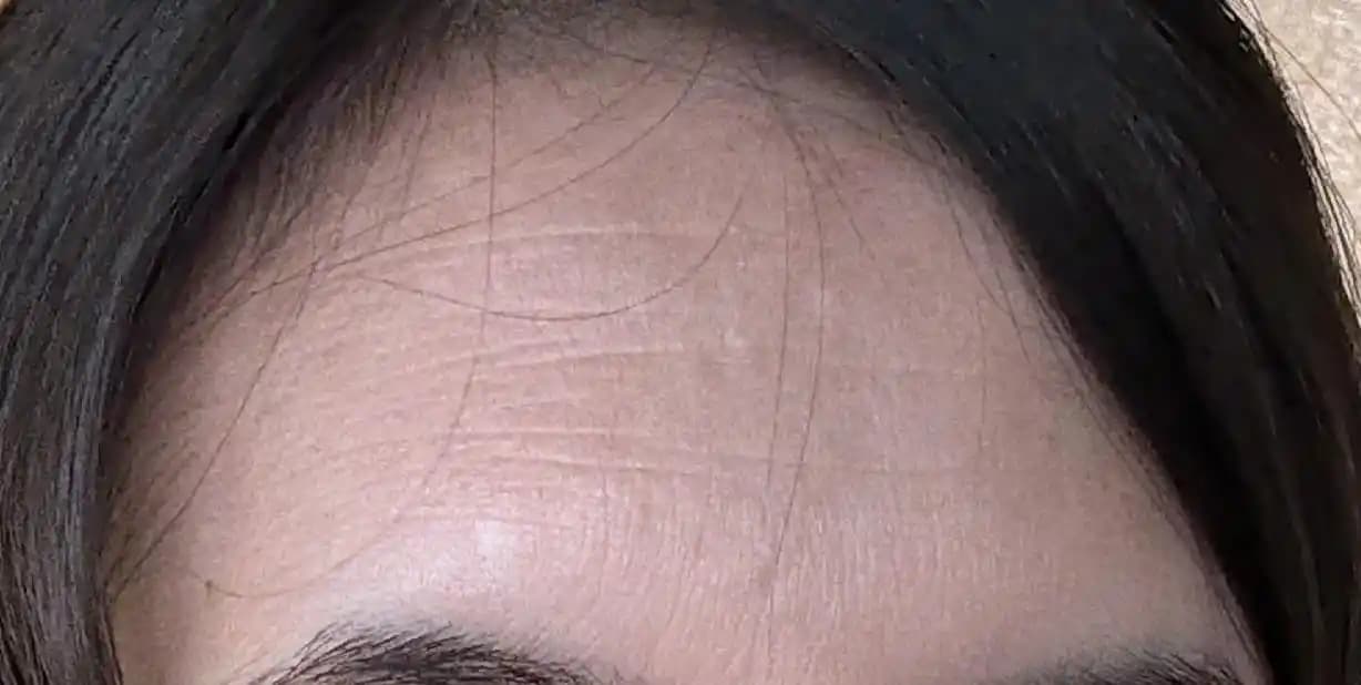 Alın Kırışıklıklarının Geri Döndürülmesi: Klinik ve Topikal Yöntemlerle Cilt Bakımı