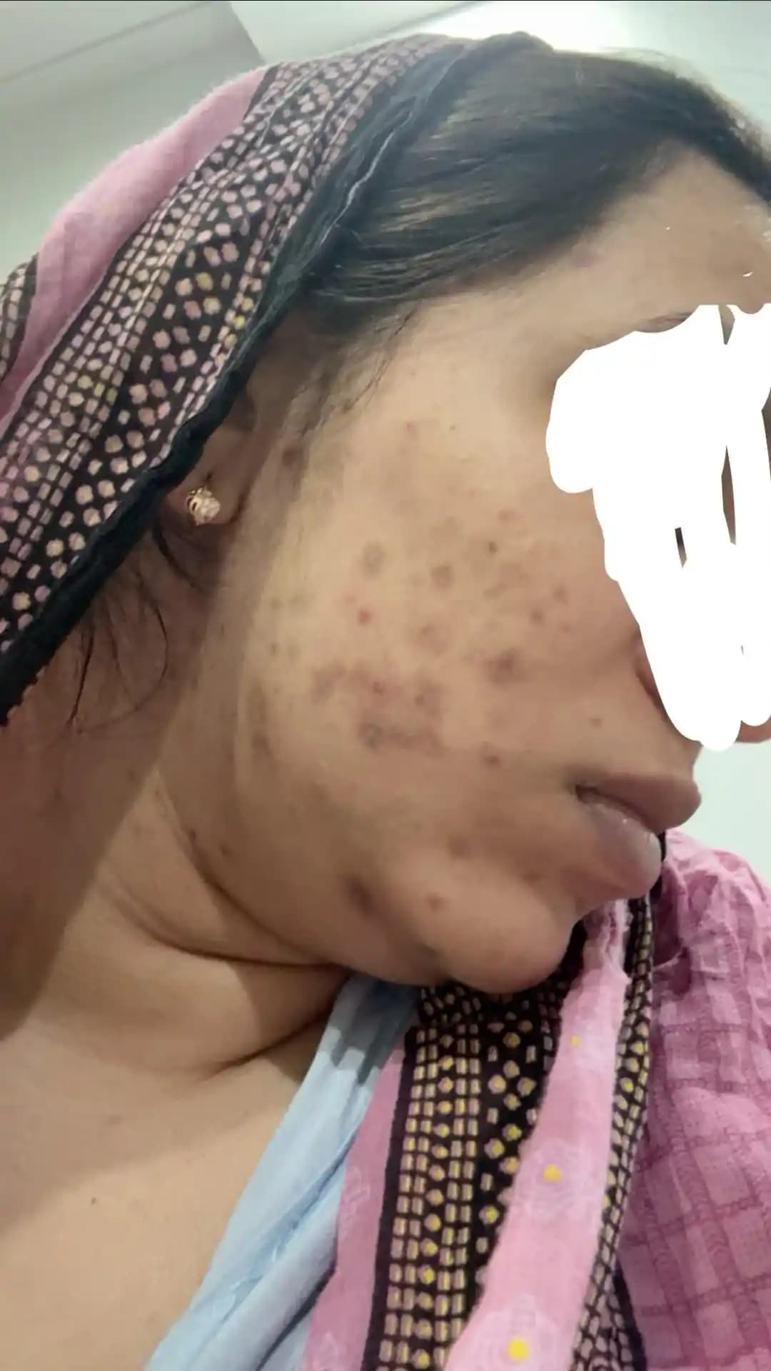 Ani ve Şiddetli Akne Problemleri: Nedenleri, Tedavi Yöntemleri ve Cilt Bakımı Rehberi