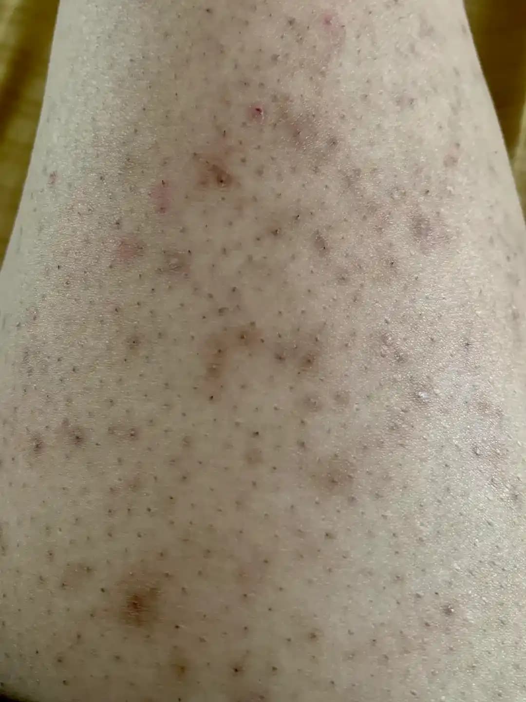 Bacaklarda Batık Tüy Sorunları ve Etkili Tedavi Yöntemleri Üzerine Kapsamlı Rehber