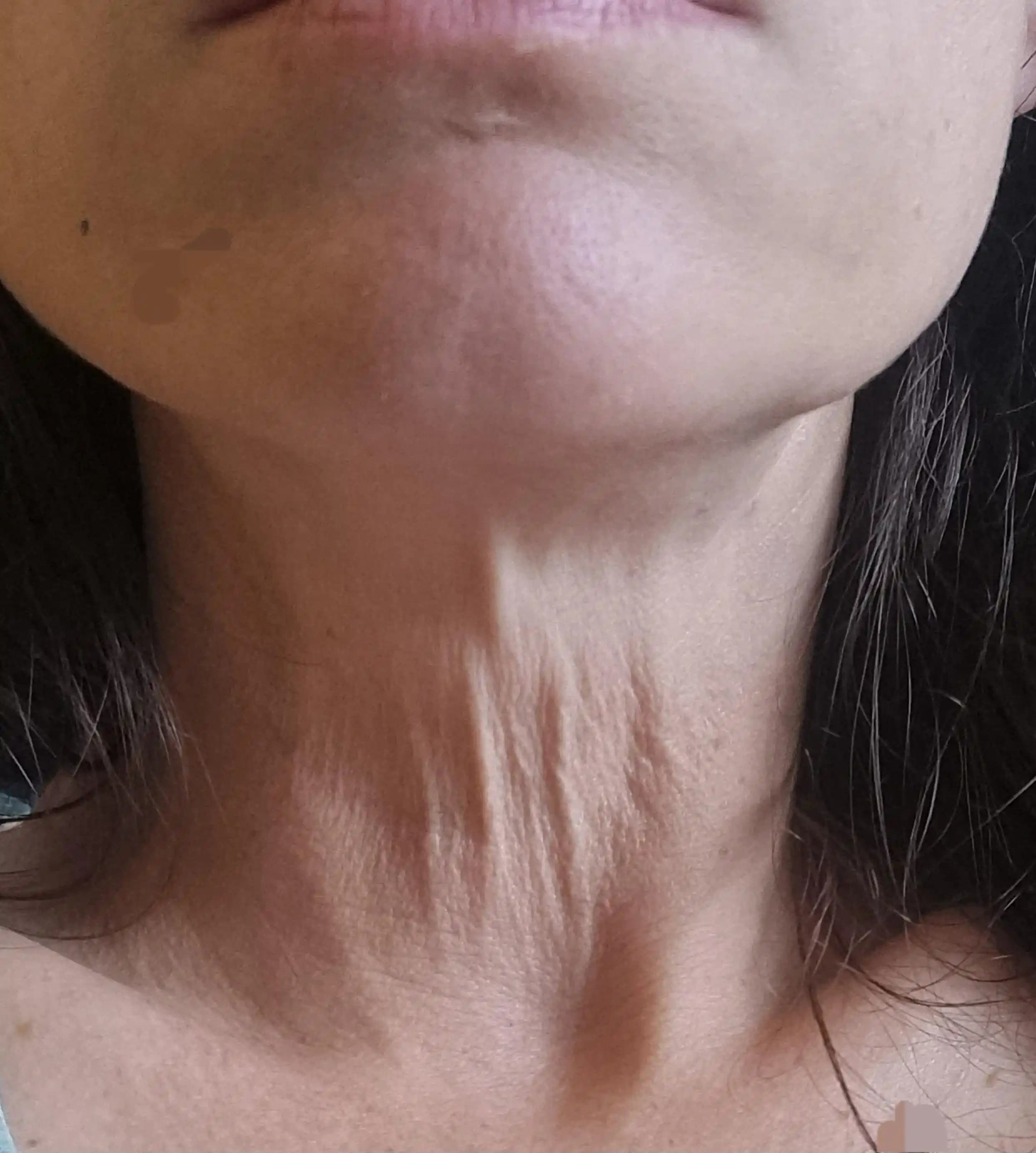 Boyun Cildinde Yaşlanma Süreci ve Cerrahi Olmayan Tedavi Yöntemleri Üzerine İnceleme