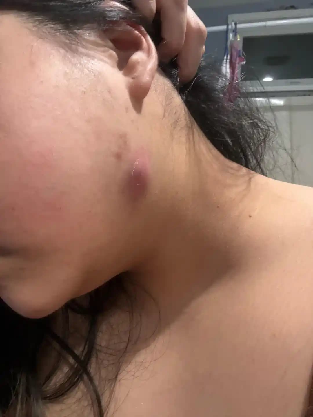 Büyük ve Ağrılı Sivilceler: Kistik Akne Nedenleri ve Etkili Tedavi Yöntemleri