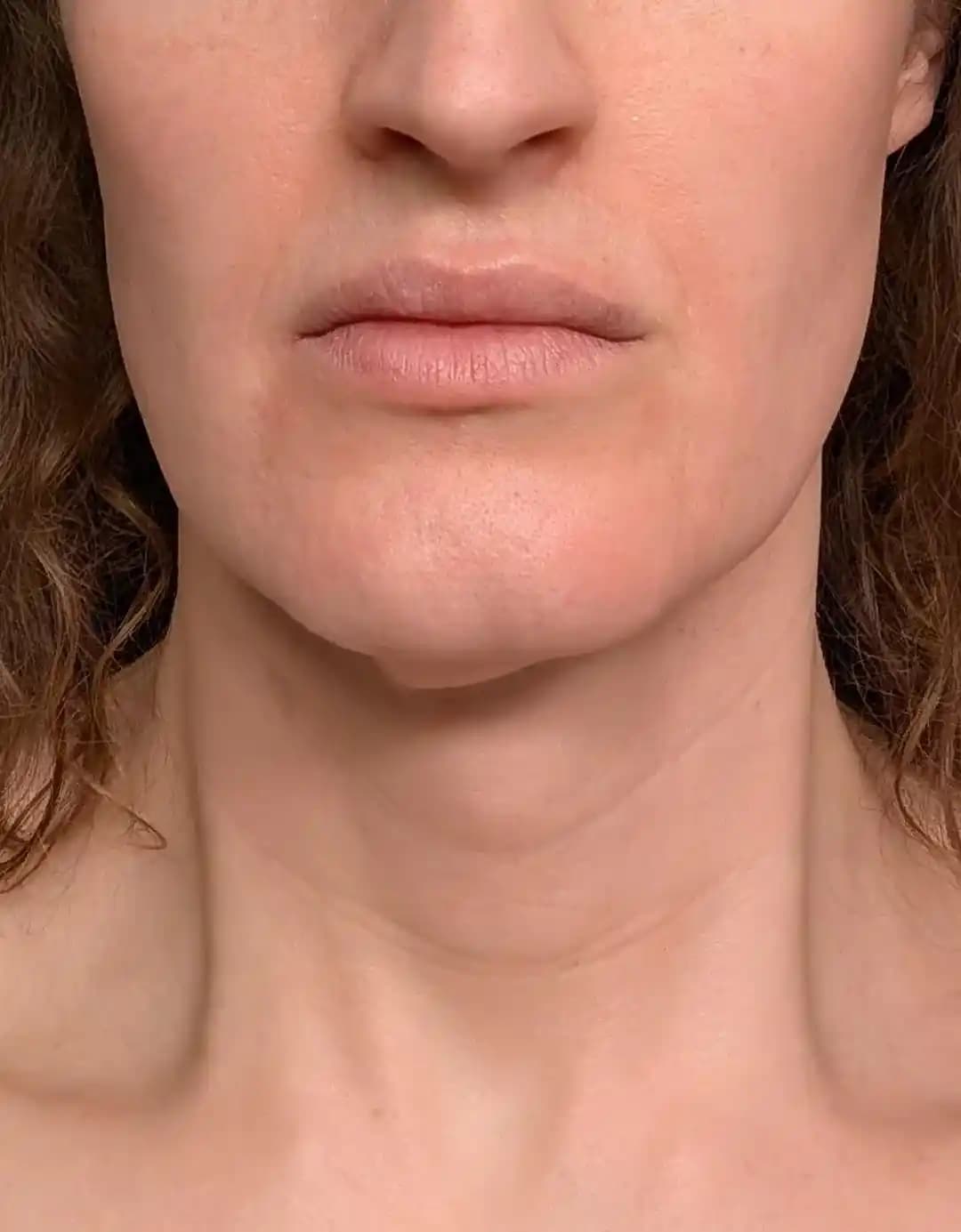 Çene ve Boyun Bölgesinde Sarkan Cilt: Nedenleri, Tedavi ve Bakım Yöntemleri