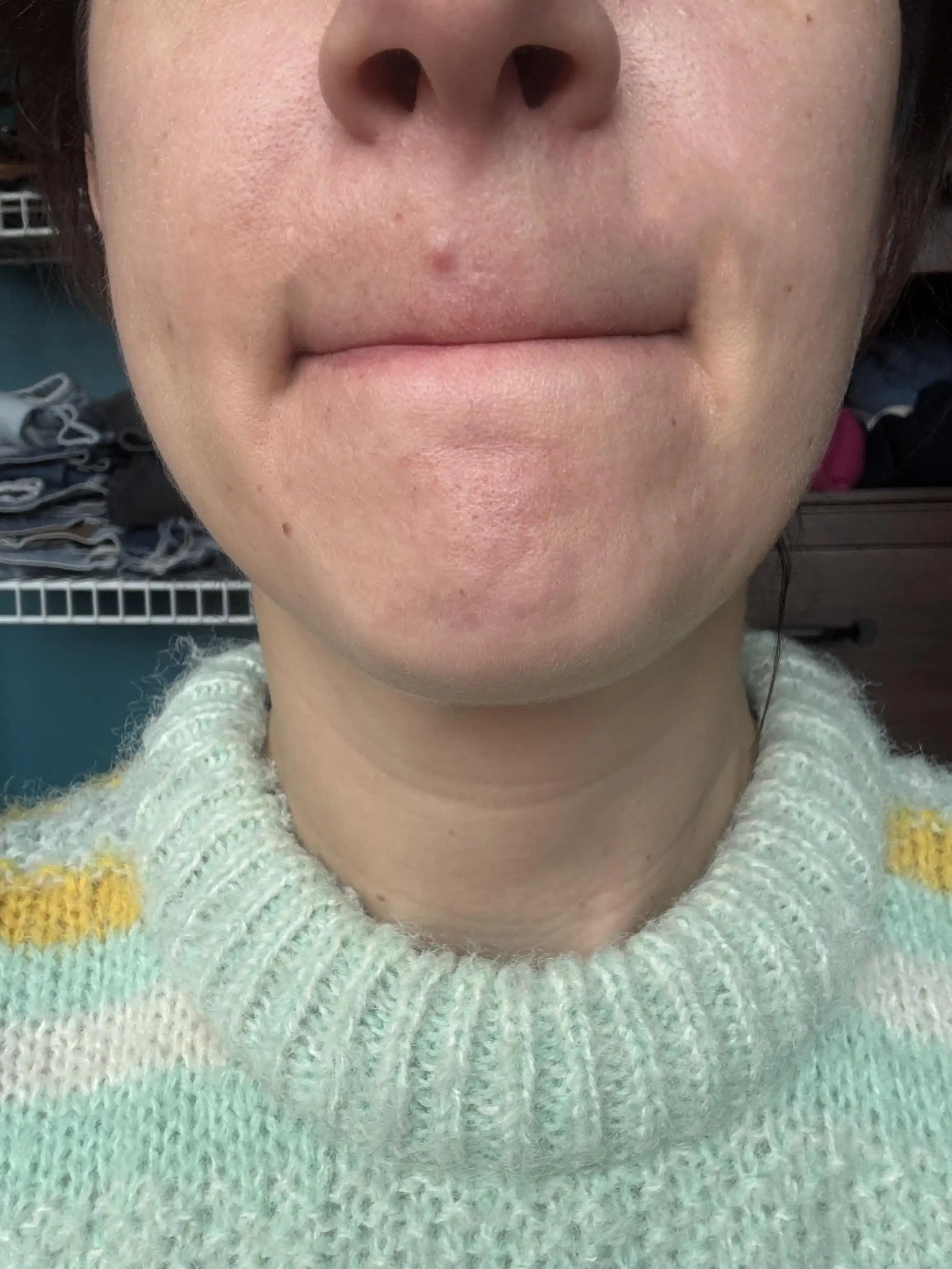 Cilt Altı Sivilceler: Nedenleri, Tedavi Yöntemleri ve İyileşme Süreci Hakkında Bilgiler