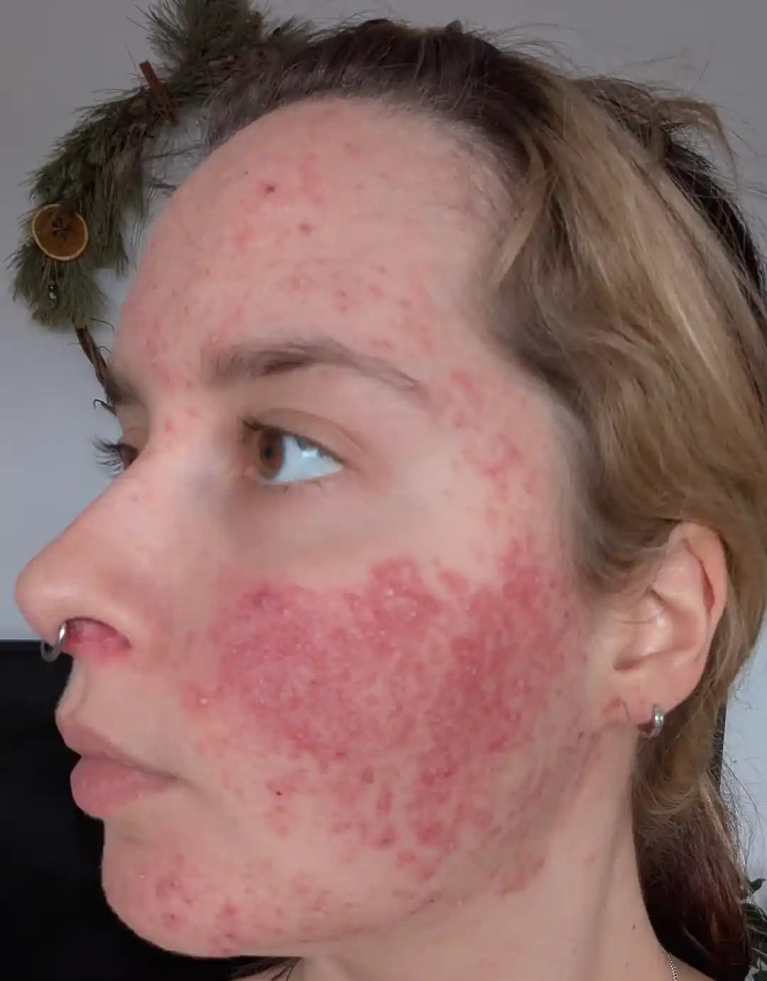 Cilt Sağlığında İyileşme Yöntemleri: Bariyer Onarımı ve Bağırsak Sağlığının Rolü