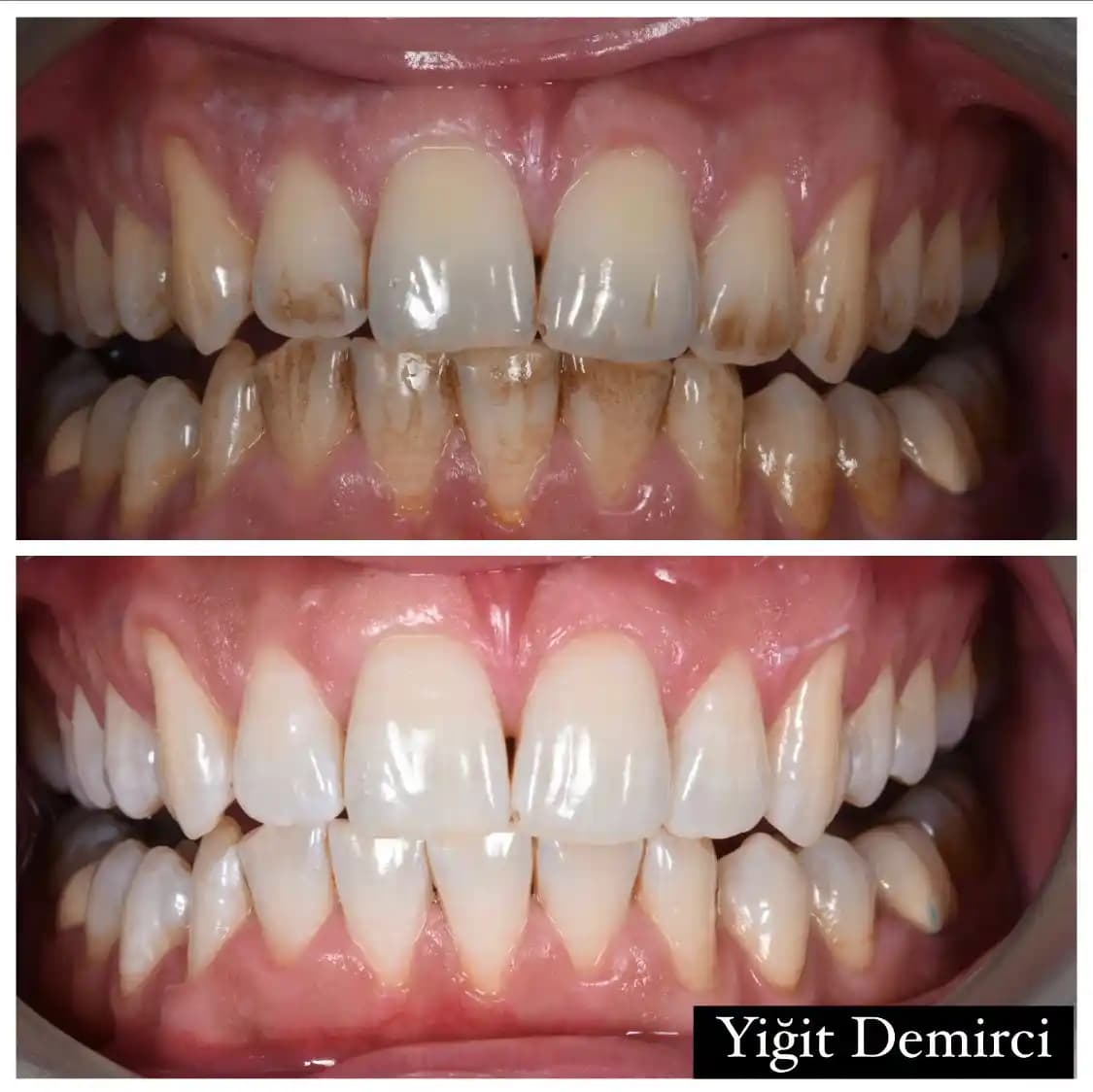 Çok Beyaz Dişlere Sahip Olmanın Yöntemleri ve Genetik Etkilerinin İncelenmesi