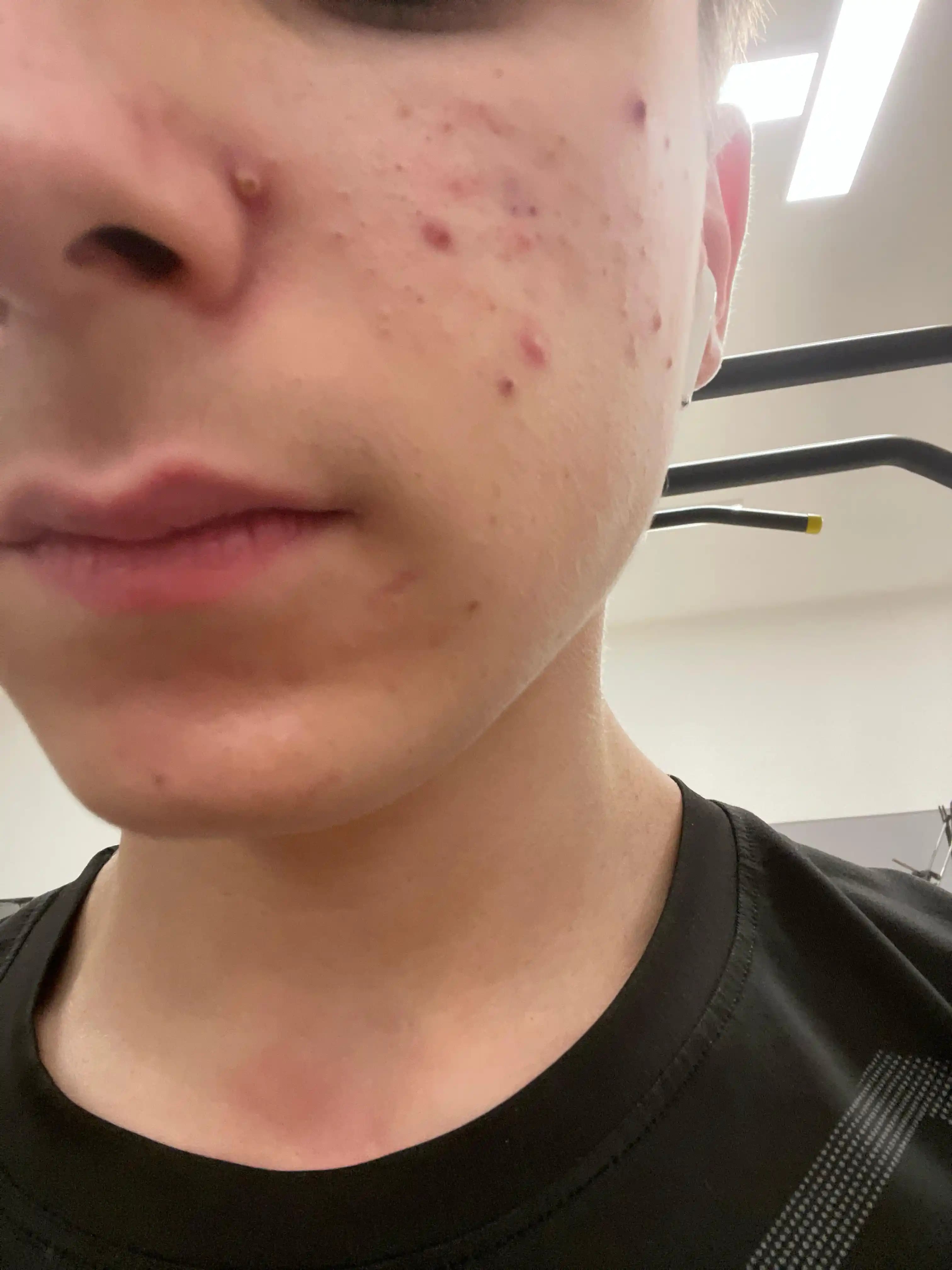 Ergenlikte Akne: Seyri, Tedavi Yöntemleri ve Cilt Bakımının Önemi