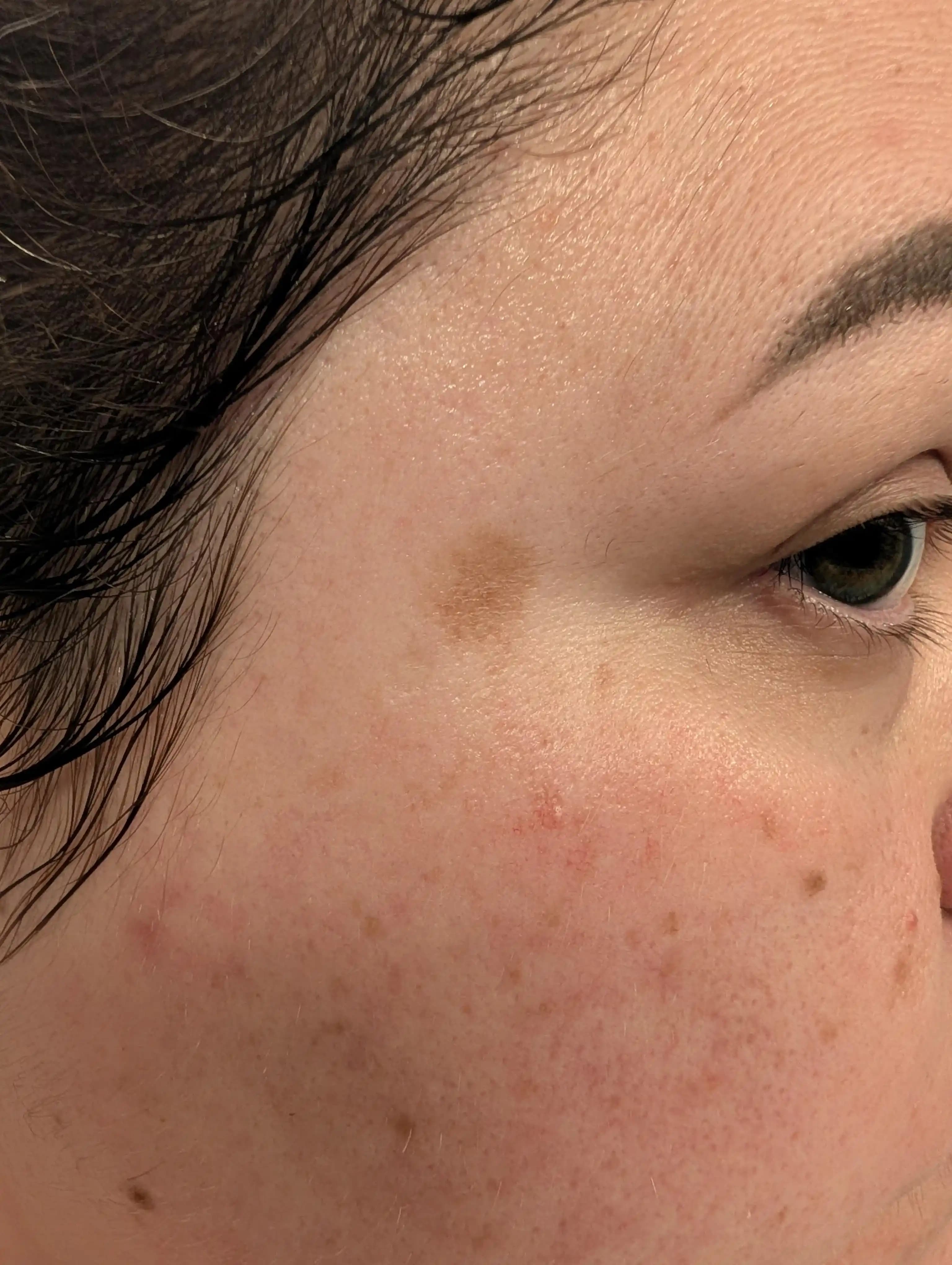 Güneş Lekeleri İçin Etkili Tedavi Yöntemleri ve Koruyucu Öneriler