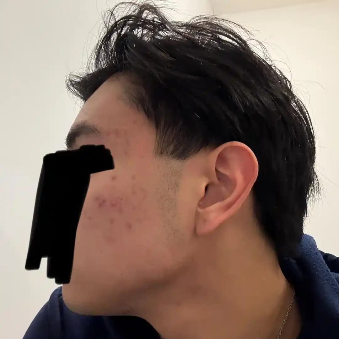 Hormonal Akne Tedavisinde Basit ve Etkili Dermatolojik Yaklaşım: Bir Yılın Değerlendirmesi