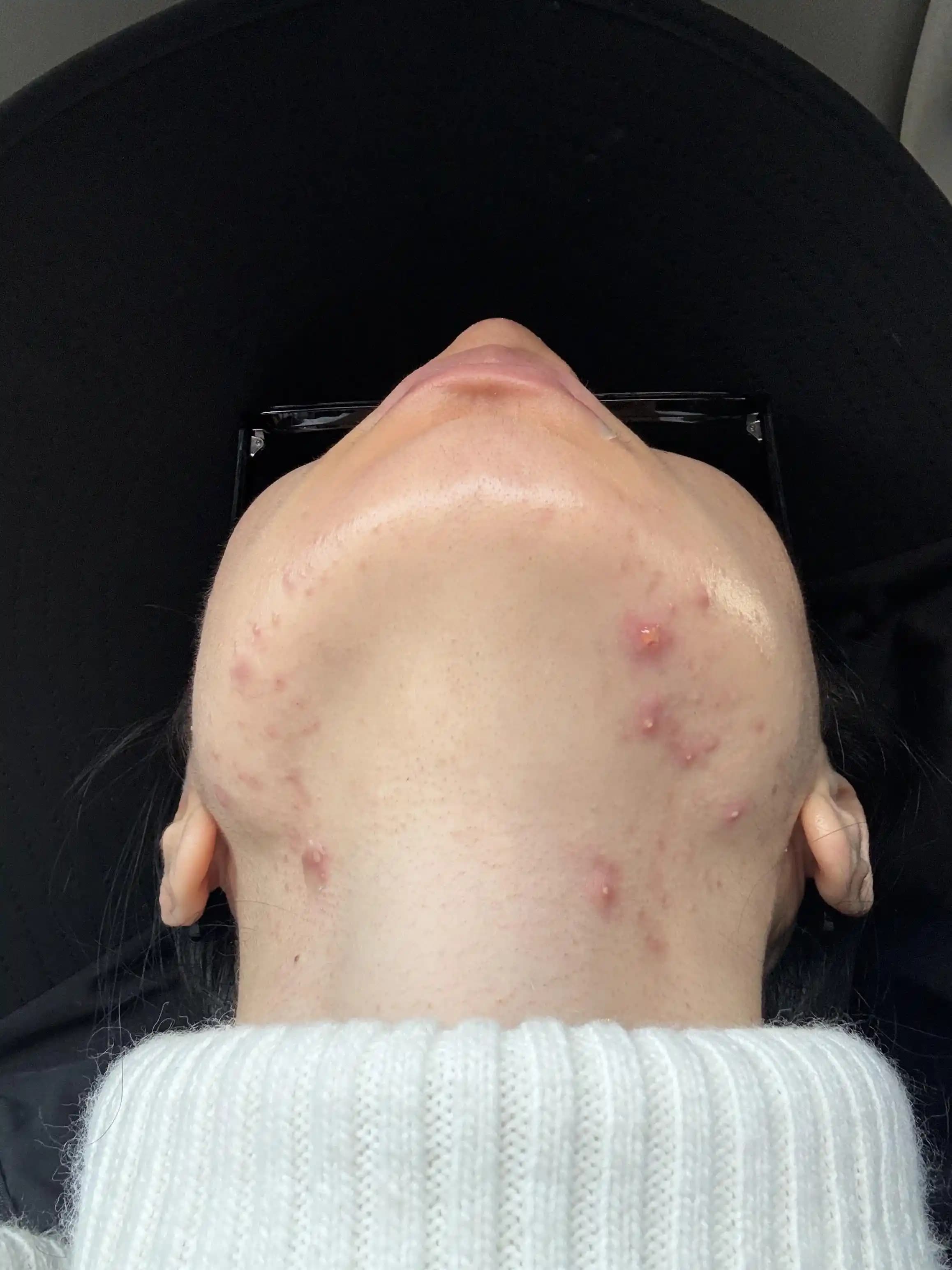 Hormonal Akne Tedavisinde Medikal ve Alternatif Yöntemlerin Kapsamlı İncelemesi