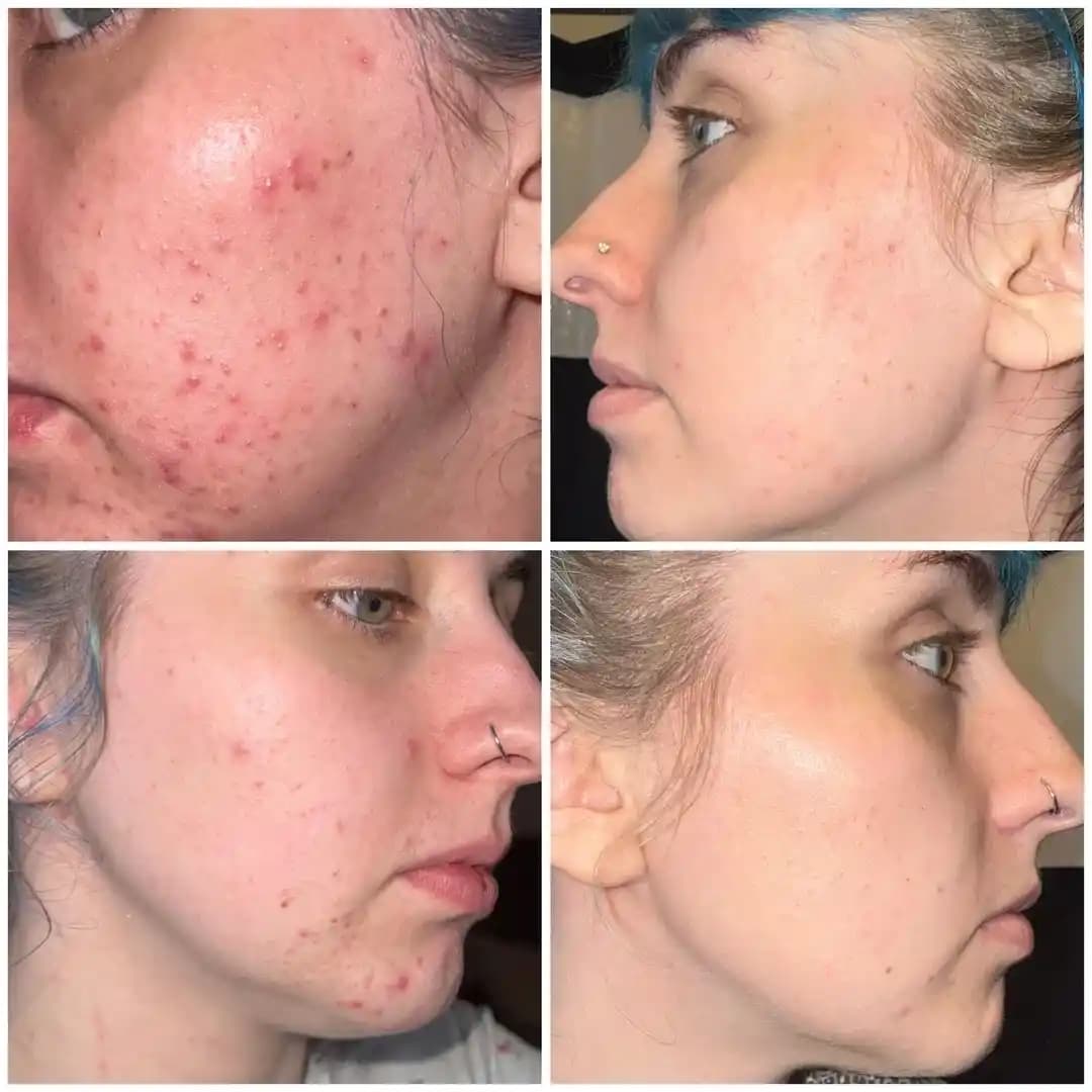 Hormonal Akne Tedavisinde Spironolaktonun Etkisi ve Kullanıcı Deneyimleri