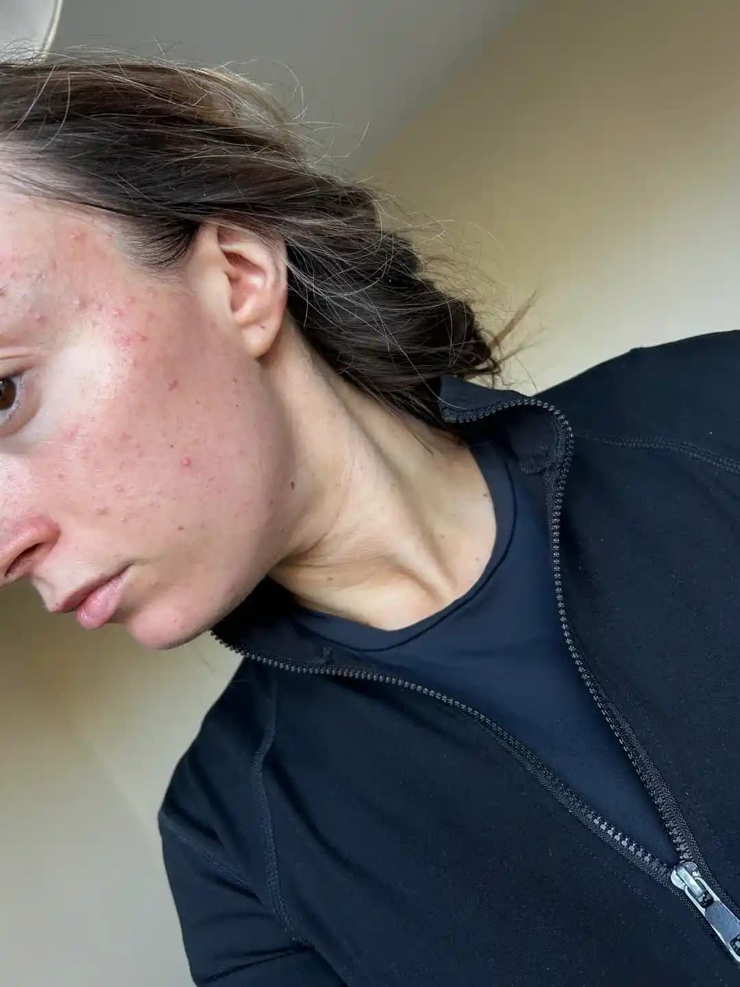 İngiltere'deki Sert Su ve İklim Koşullarının Cilt Sağlığı Üzerindeki Etkileri ve Bakım Önerileri