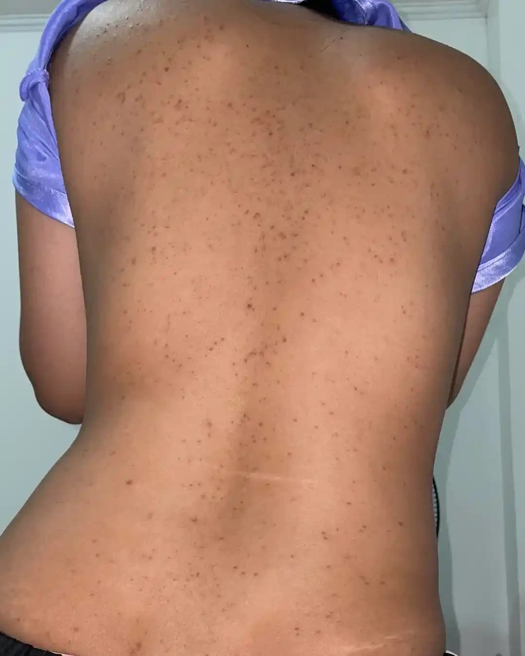 Sırt Aknesi ve Koyu Lekelerle Mücadelede Etkili Temizlik ve Tedavi Yöntemleri