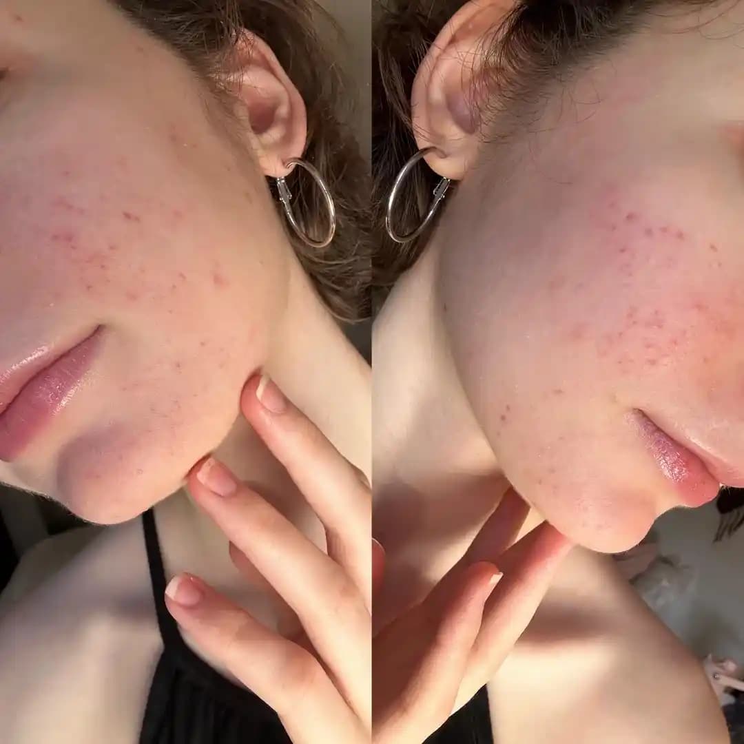 Tretinoin Kullanımının Cilt Bariyerine Etkileri ve La Roche-Posay Cicaplast B5'in Rolü