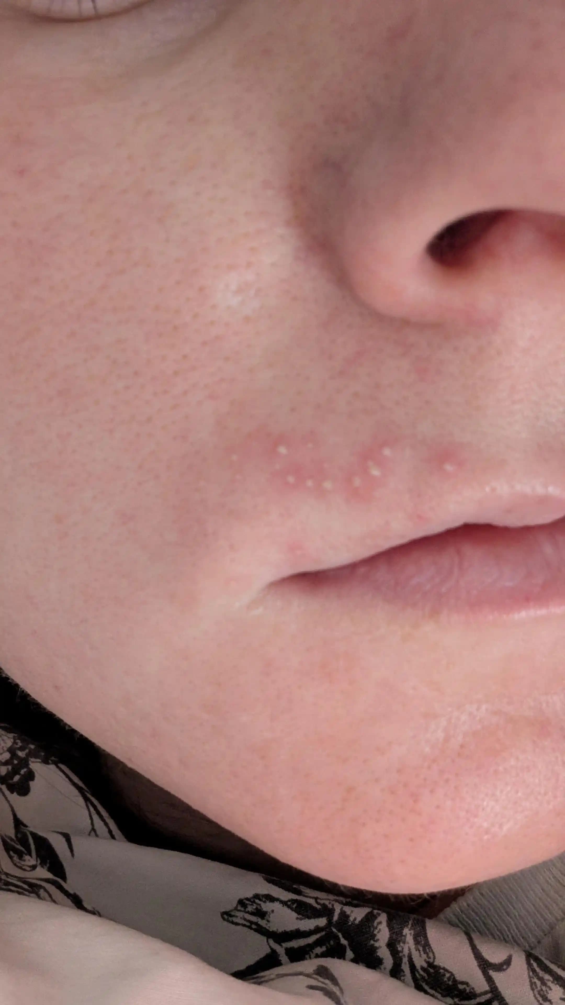 Yüz Ağdası Sonrası Dudak ve Yüz Bölgesinde Sivilce Oluşumu: Nedenler ve Çözüm Önerileri