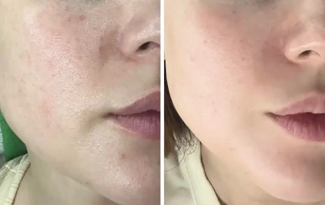 Azelaik Asit ve Laktik Asit: Cilt Bakımında Gözenek ve Ton Eşitsizliği İçin Etkili Çözüm