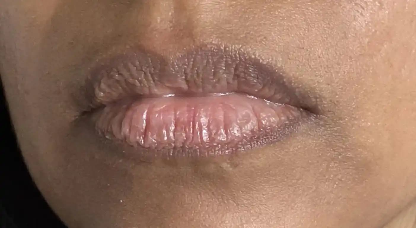 Dudaklarda Kırışıklık, Çizgilenme ve Kuruluk: Nedenleri ve Etkili Bakım Yöntemleri