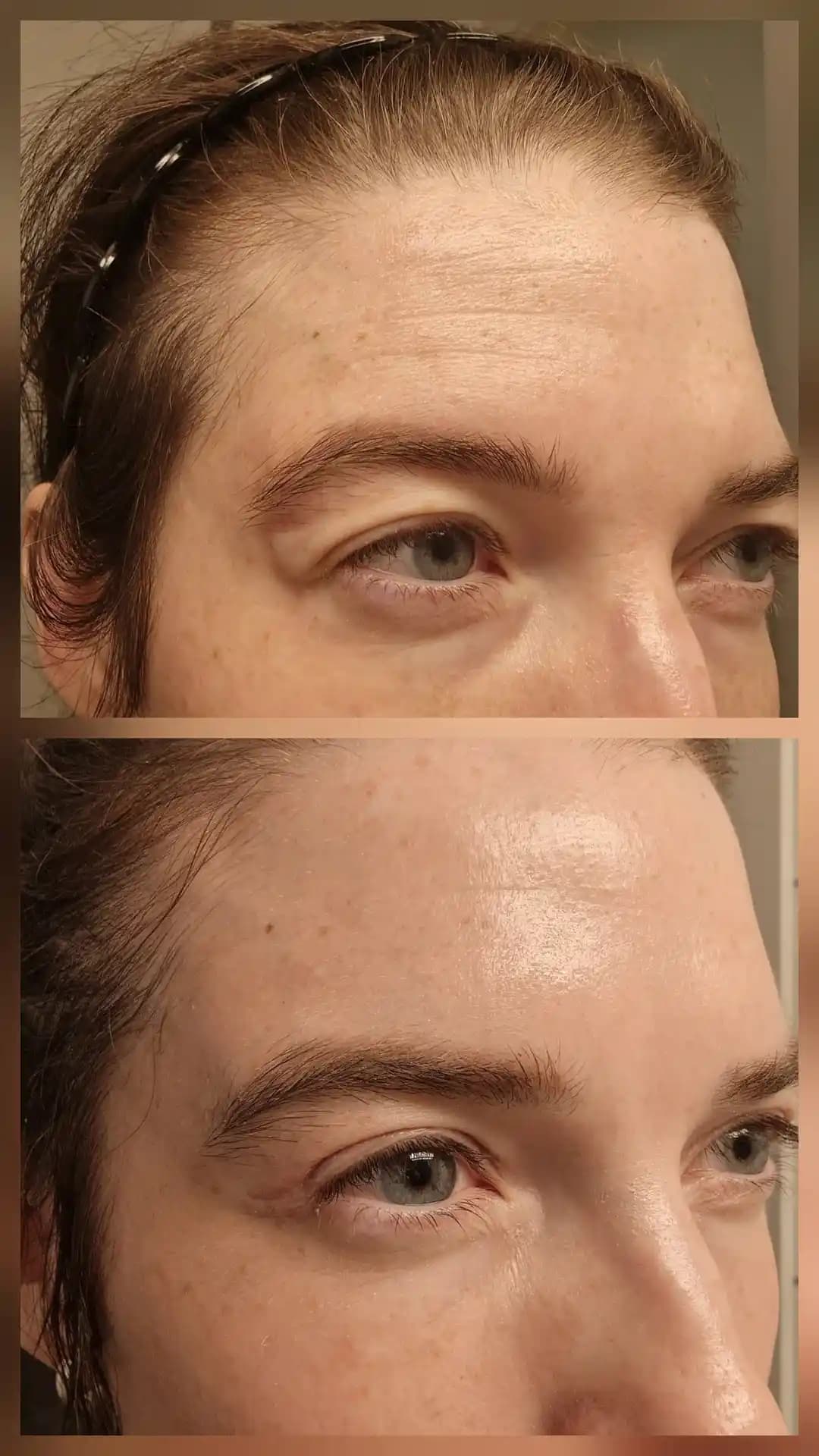 Kış Aylarında Güneş Koruyucu ve Tretinoin Kullanımı: Norveç'ten Cilt Bakım Deneyimi