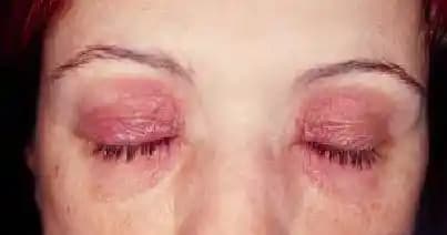 Parfüm Kullanımında Göz Kapağı Dermatitine Karşı Katı Parfüm Formülasyonu ve Çözümleri