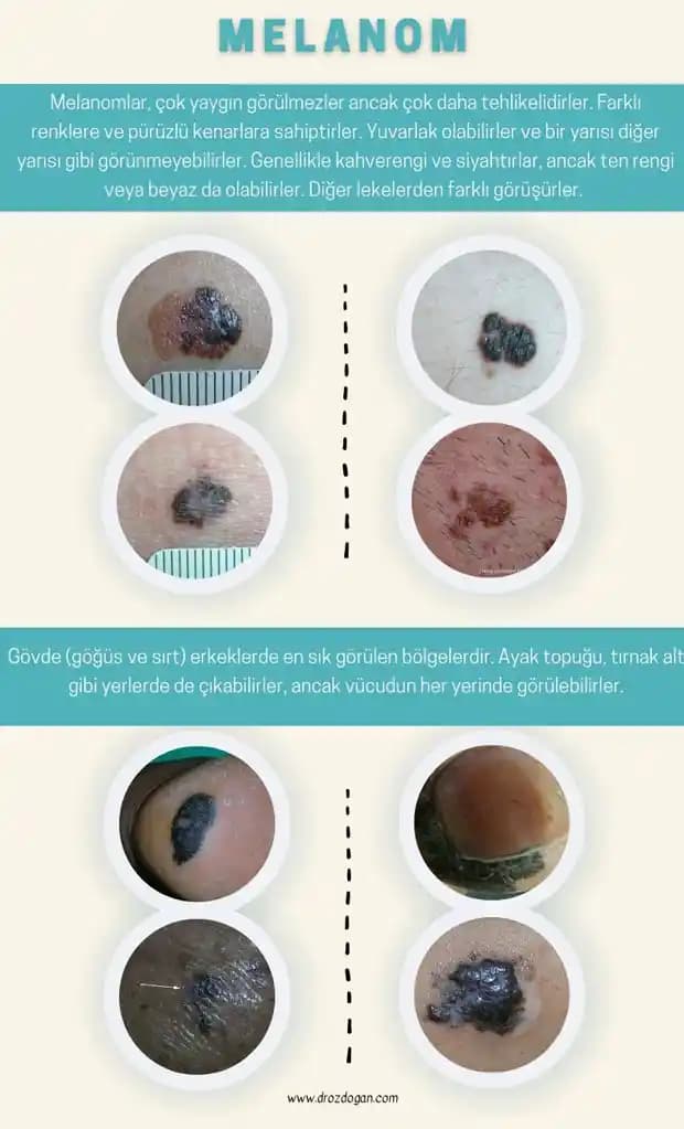 Vücut İçin Güneş Koruyucu Kullanımı ve Cilt Kanseri Önlemleri Hakkında Kapsamlı Rehber