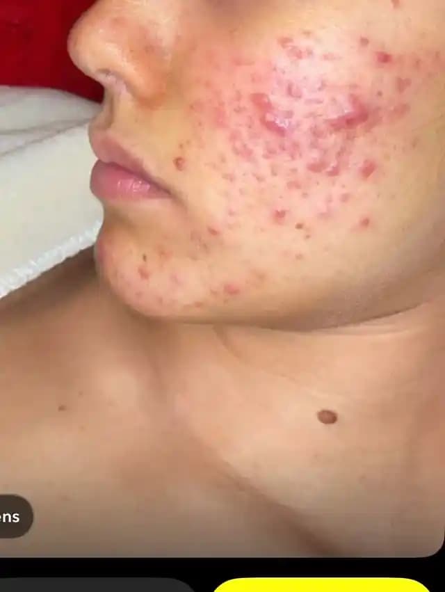 Akne Tedavisinde Accutane ve Hormonal Yaklaşımlar: PCOS ve Yan Etkiler Üzerine Detaylı İnceleme