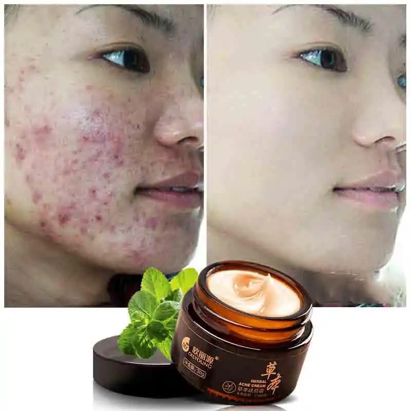 Asya Güzellik Ürünlerinde Leke Giderici Etkili İçerikler ve Tedavi Yöntemleri