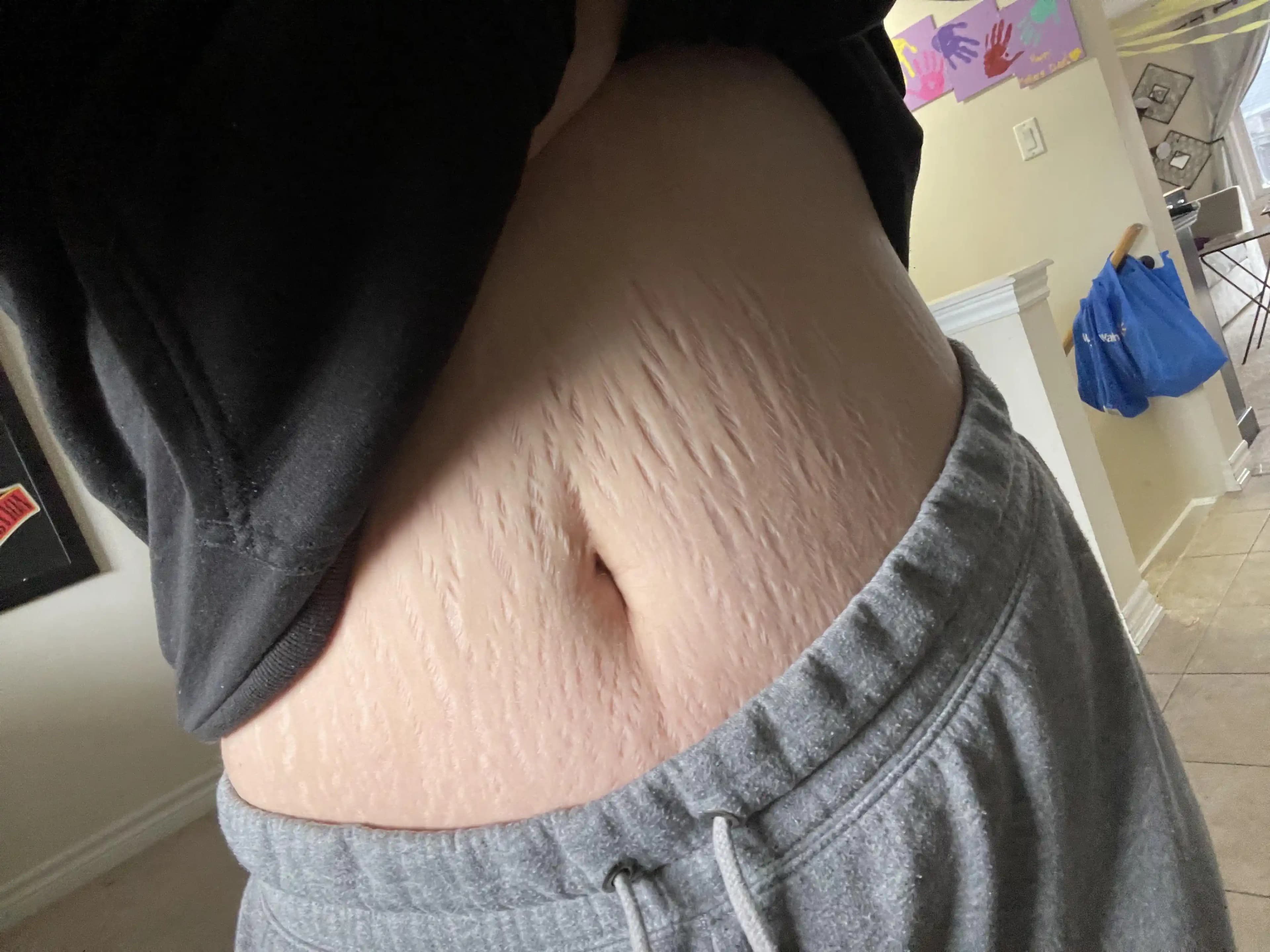 Çatlak İzleri İçin Etkili Tedavi Yöntemleri ve Bakım Önerileri