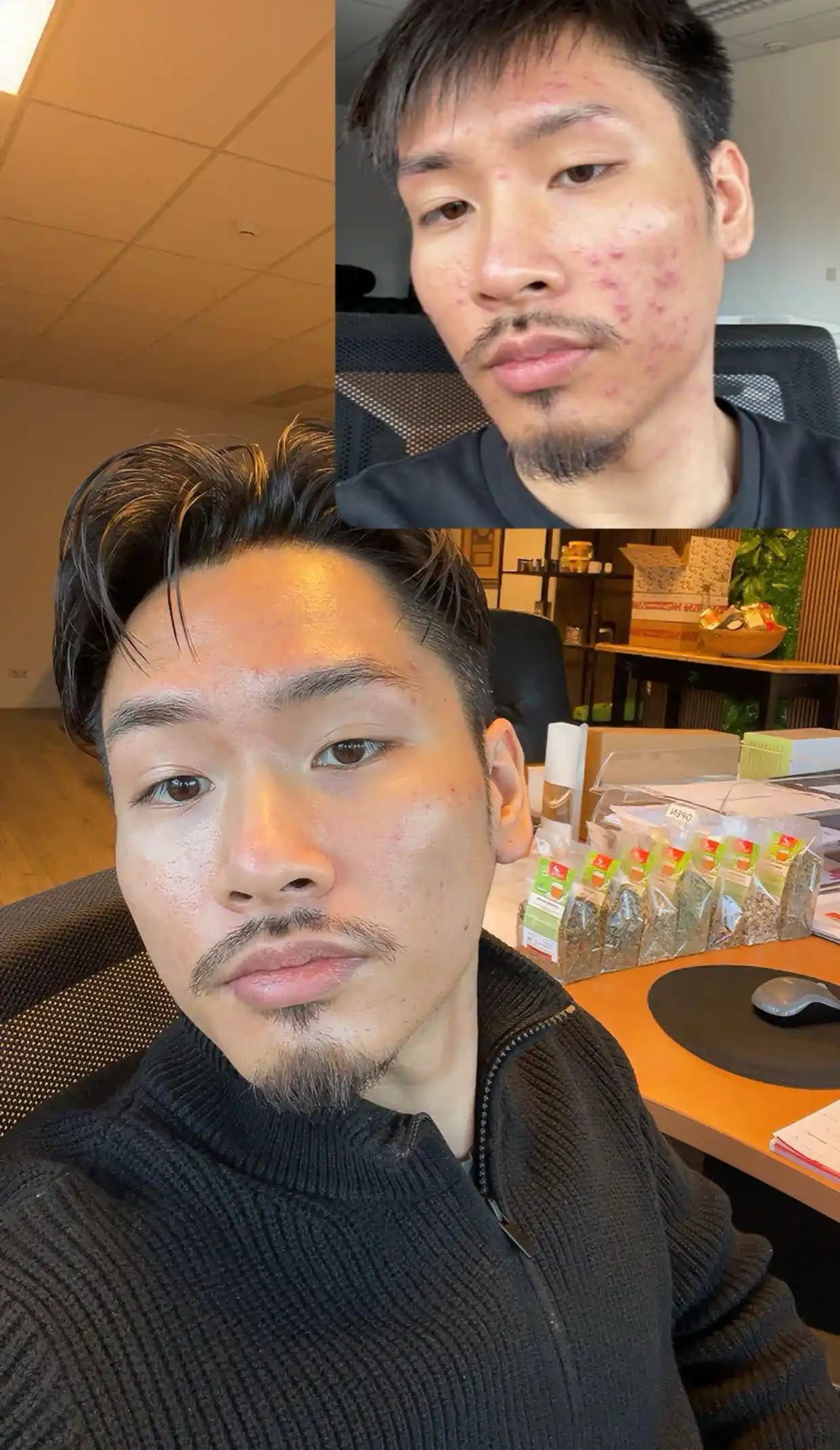 Differin %0,1 Jel ile 3 Aylık Cilt Bakım Deneyimi ve Etkili İpuçları