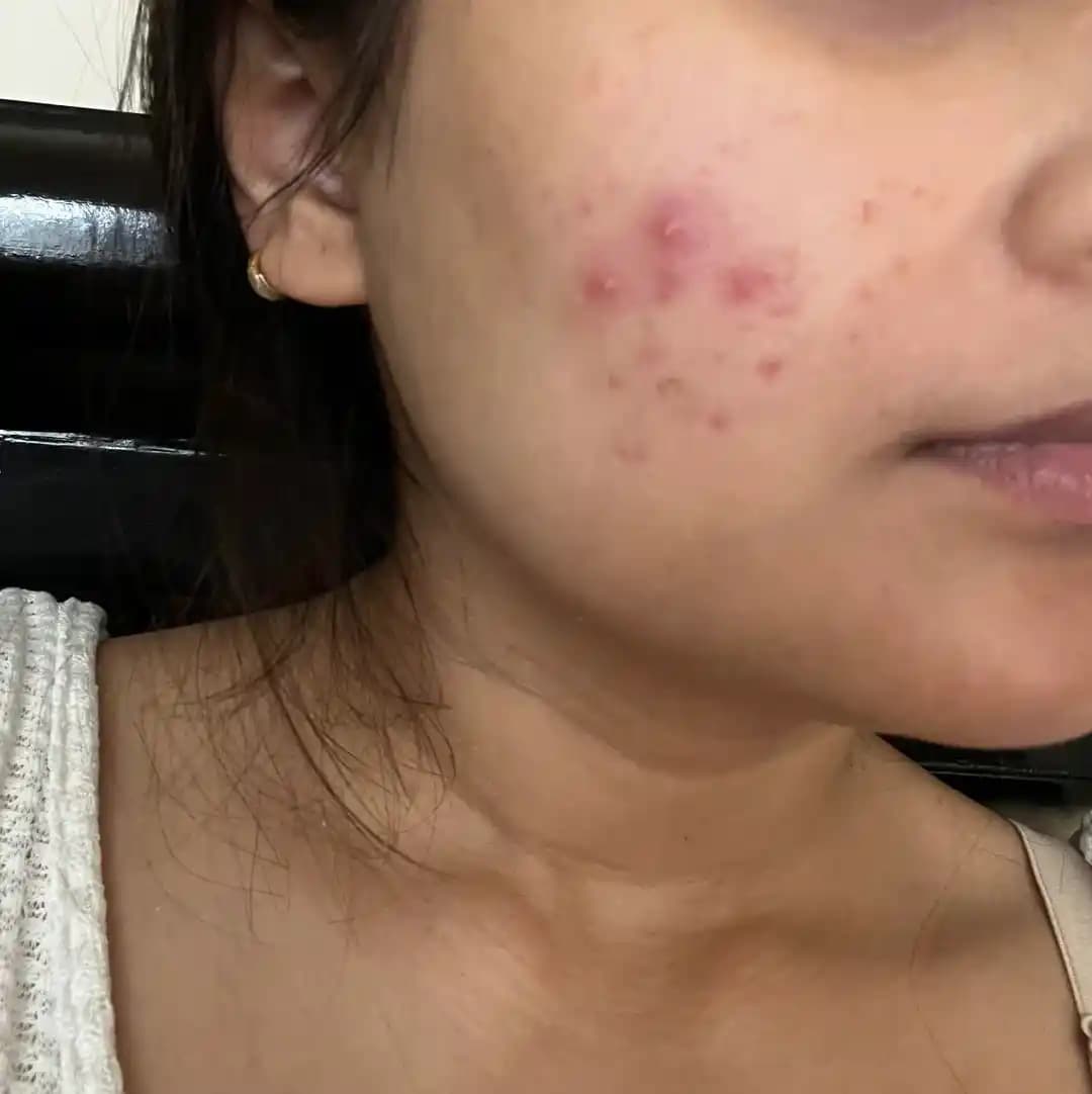 Düğüne Kısa Sürede Ortaya Çıkan Akne Problemleri ve Etkili Tedavi Yöntemleri