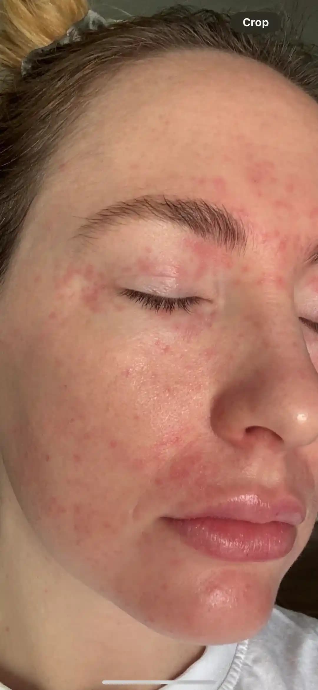 Hamilelik Sonrası Cilt Sorunları ve Dermatit: Tanı, Tedavi ve Bakım Yöntemleri