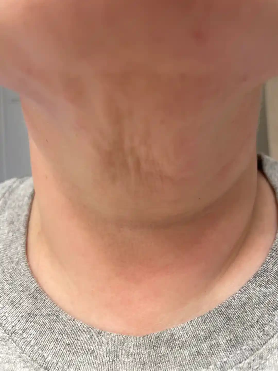 Kısa Sürede Kilo Kaybı Sonrası Boyun Derisi Sarkmaları: Nedenler ve Çözüm Yöntemleri