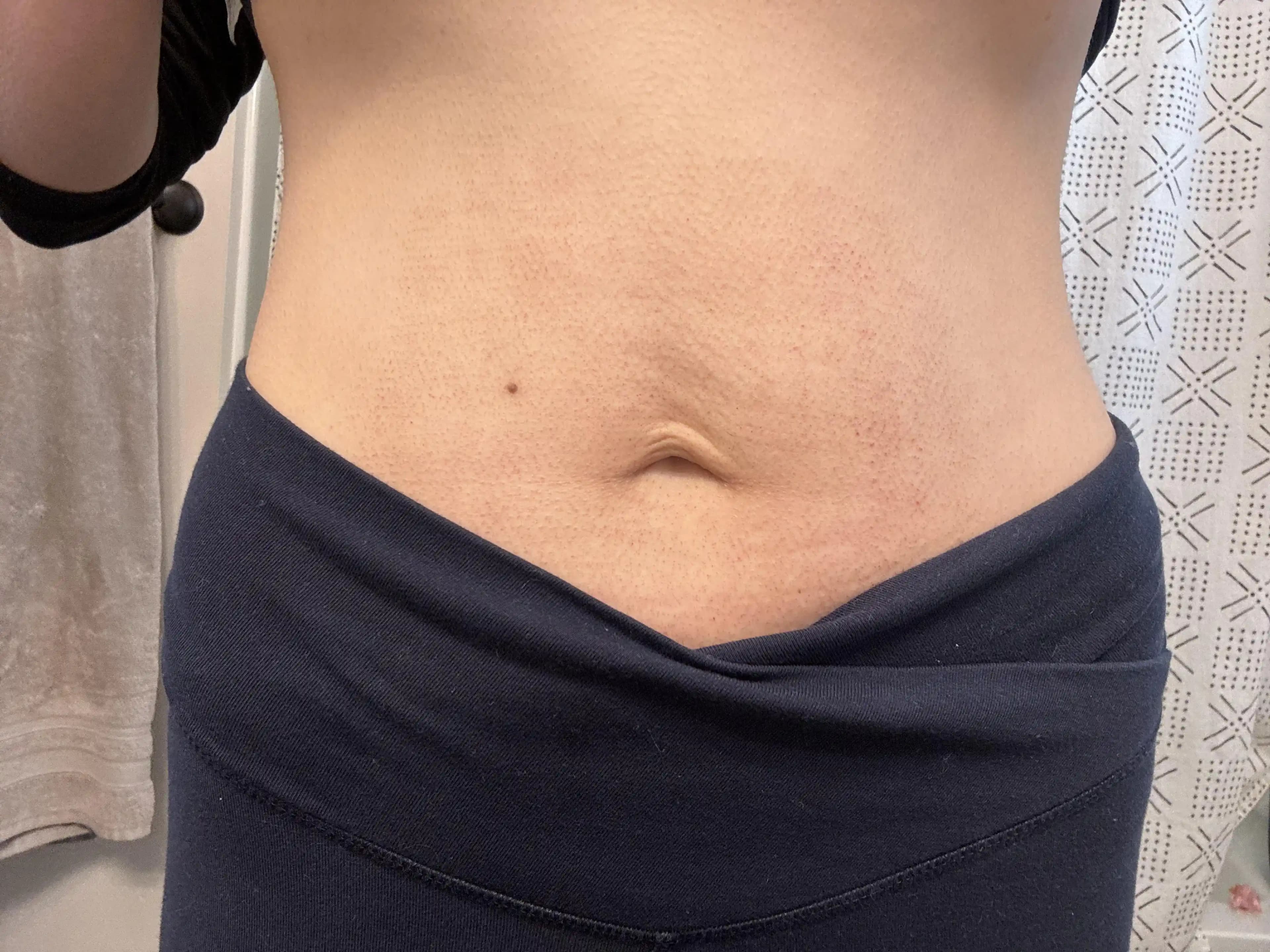 Morpheus8 Tedavisi: Gebelik ve Kilo Kaybı Sonrası Karın Derisi Sıkılaştırma Yöntemi