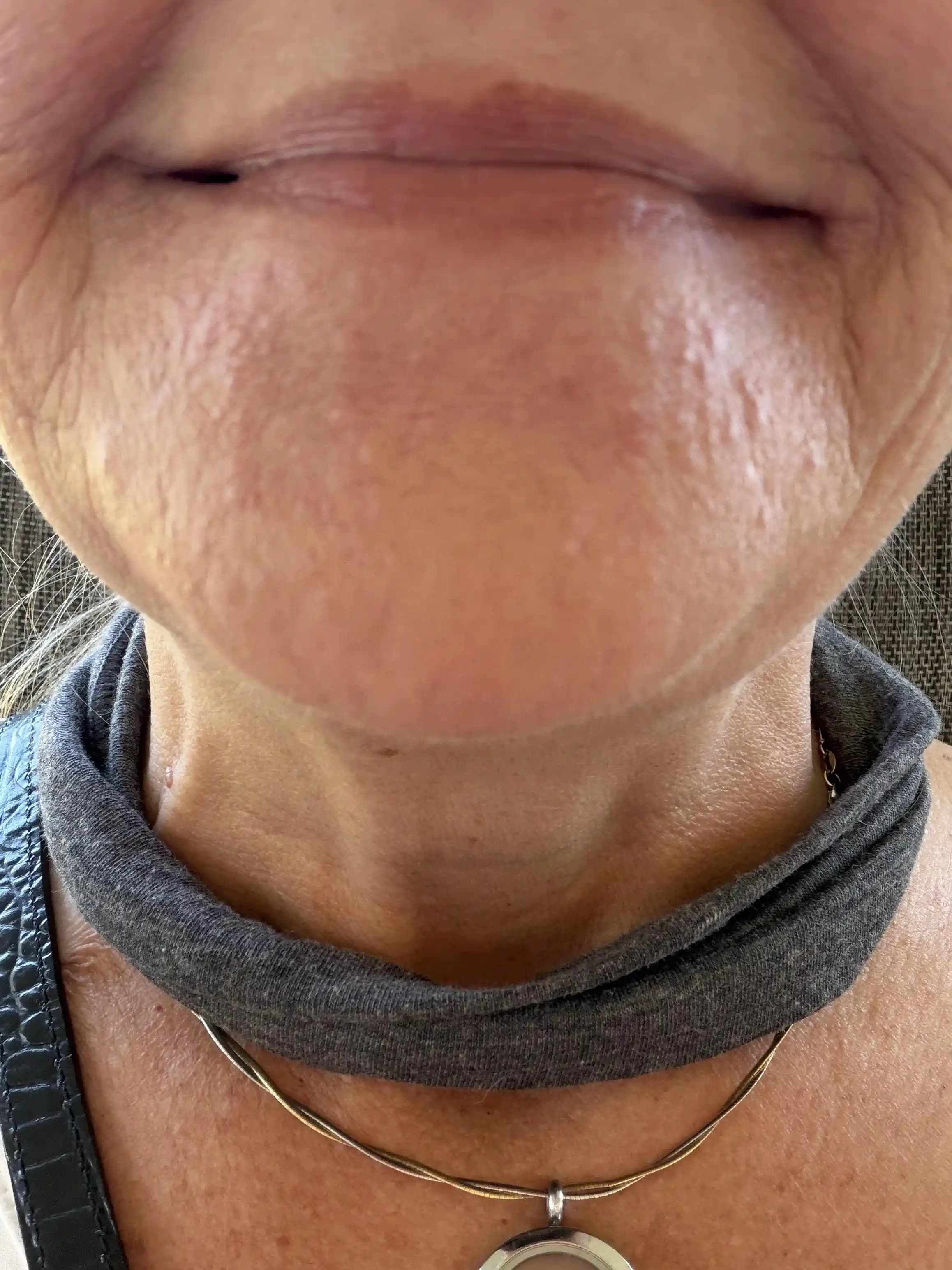 Sakal Yanığı ve Cilt Tahrişi: Nedenleri, Önleme Yöntemleri ve Tedavi Önerileri