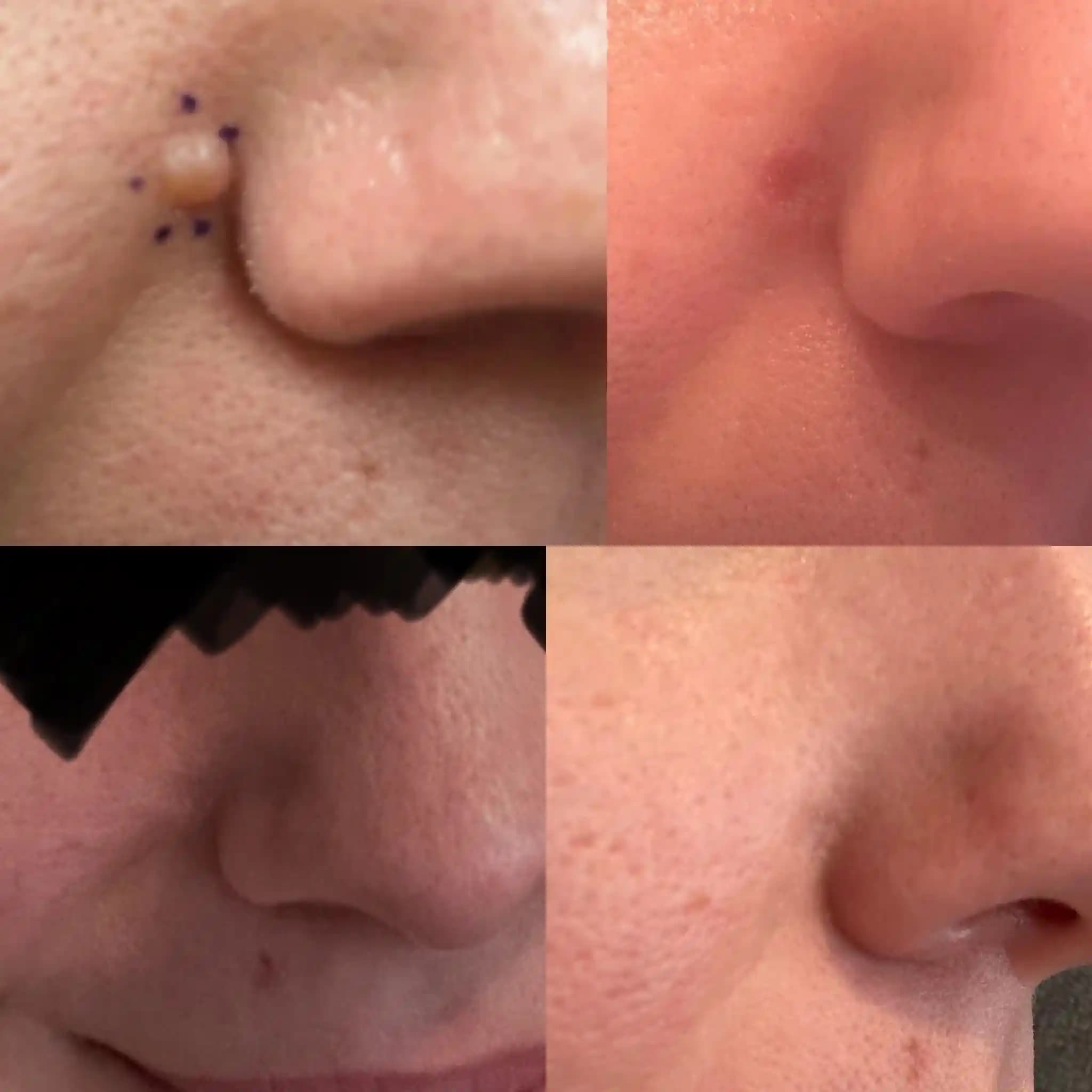 Yüzeysel Ben Alımı Sonrası Bir Yılın Sonuçları ve İyileşme Süreci Detayları