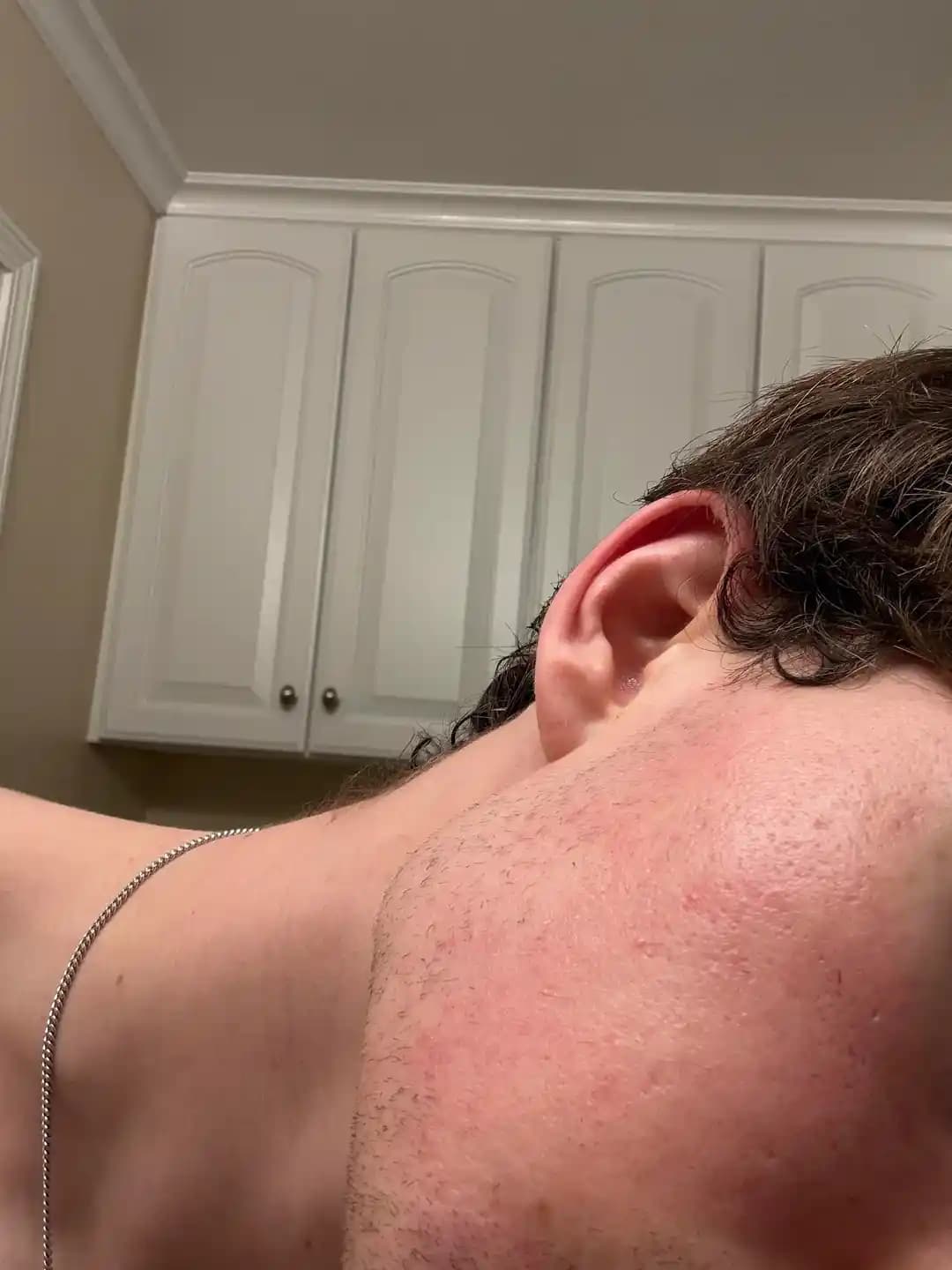 Atrofik Akne İzlerinin Değerlendirilmesi ve Etkili Tedavi Yöntemleri